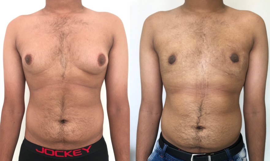 Pictures of Gynecomastia | Best Gynecomastia Surgery in Bengaluru