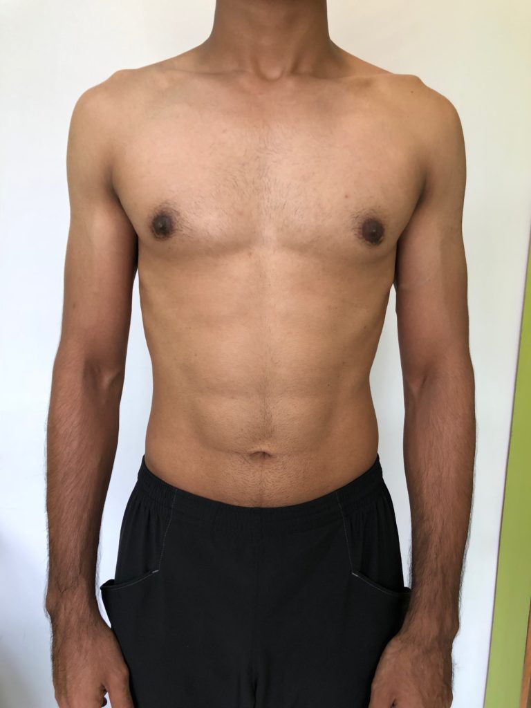 https://gynecomastiabangalore.com/wp-content/uploads/2019/11/1-768x1024.jpeg