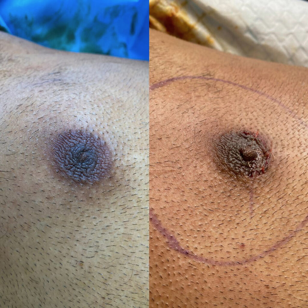 Inverted Nipple Treatment: What Works?