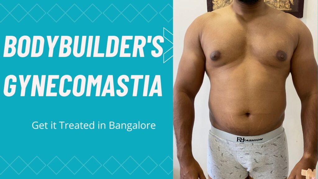 ✍️ Body Builders' Gynecomastia