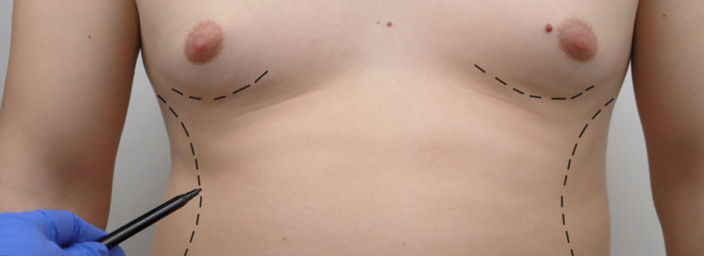 Best gynecomastia surgery hospital in Bangalore