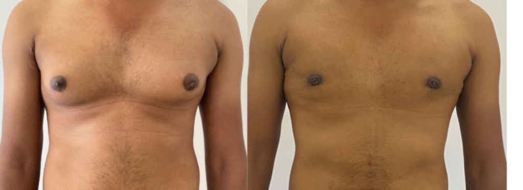 Best Gynecomastia Surgery Hospital in Bangalore