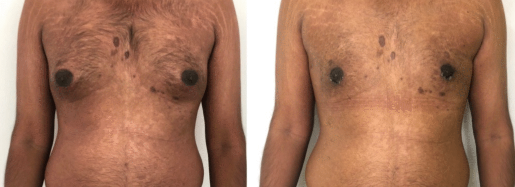 man boob surgery