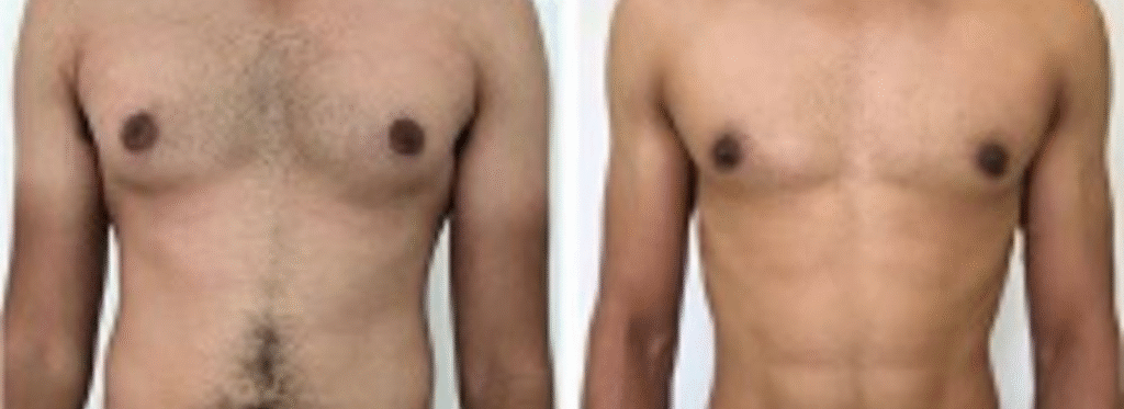 Best Male Breast Surgeon in Bangalore