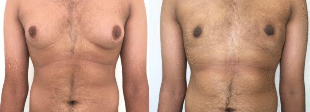 reduce male breast